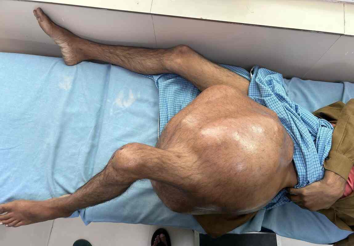 एम्स ऋषिकेशः सर्जरी से हटाया 35 किलो का बोन ट्यूमर, रचा इतिहास